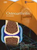 Osteoarthritis - MPHOnline.com