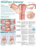 Understanding Ovarian Cancer Anatomical Chart - MPHOnline.com